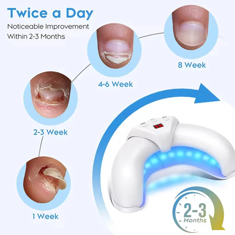 Hign Concerned Fungal Nail Laser Device For Toenail Fungus
