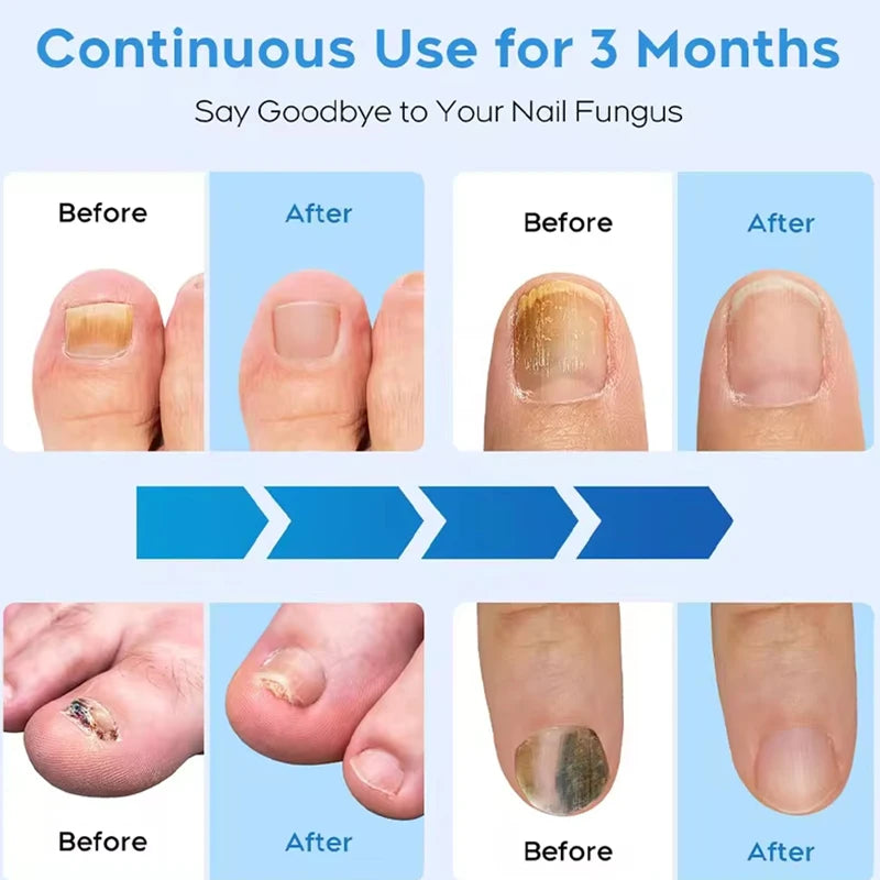 Hign Concerned Fungal Nail Laser Device For Toenail Fungus